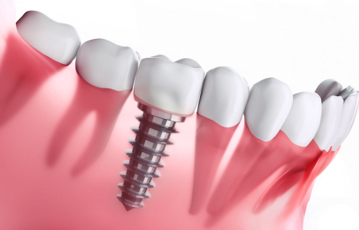 Gum disease on dental implant